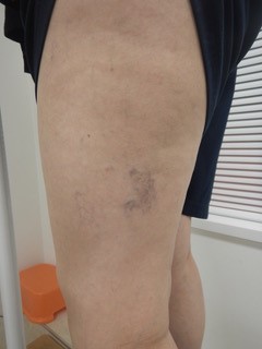 足の血管が浮き出る 大阪府大阪市の梅田血管外科クリニック
